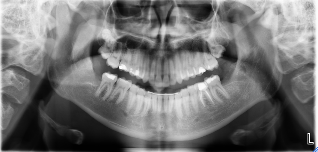 Wisdom Teeth Extraction - Caribbean Dental El Paso, Texas