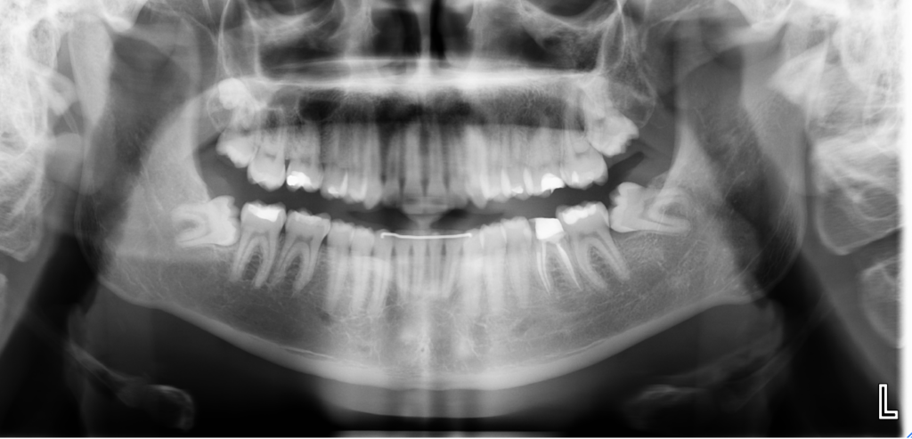 Wisdom tooth Extraction